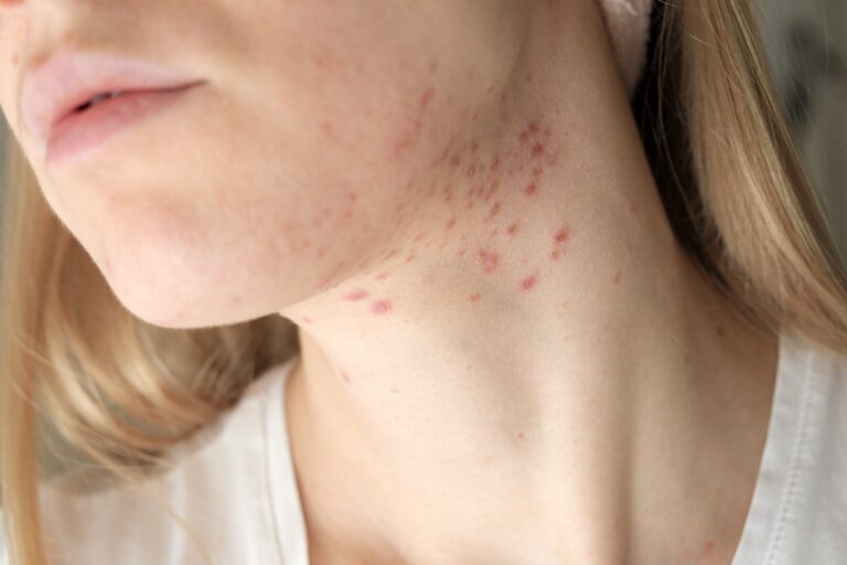 Learn about the causes of cystic pimples, and discover the best treatments for them.
