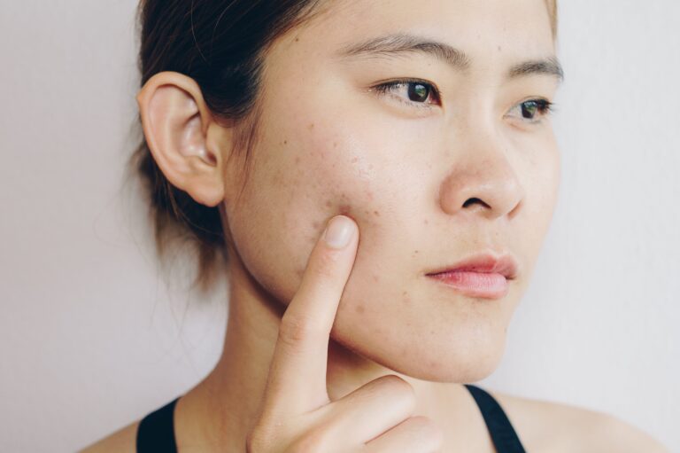 Learn how to get rid of hormonal acne in the most effective ways and find out which treatments are best for each type of acne.