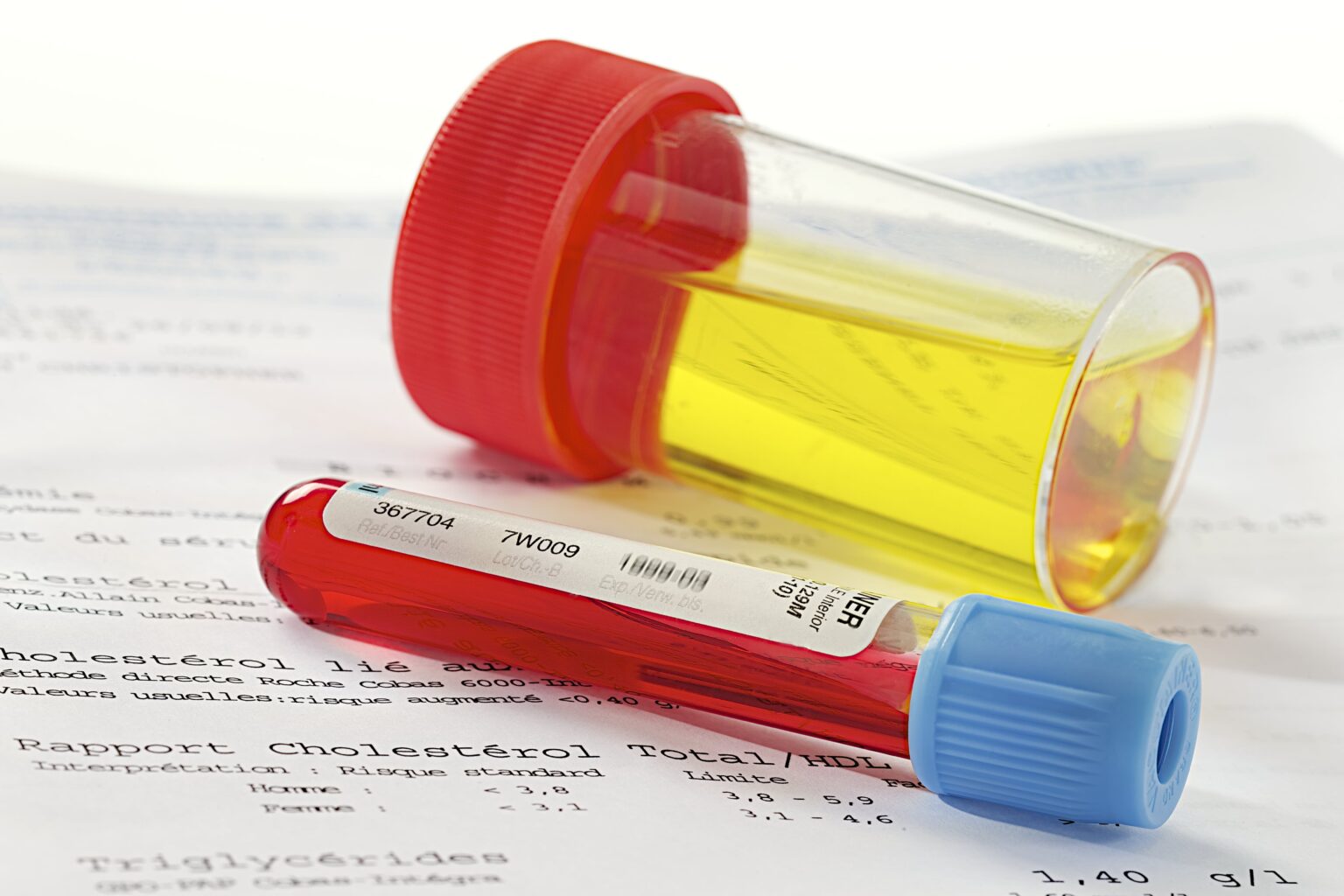 Read this article to learn about the causes and symptoms that may show up when you have elevated white blood cells in your urine.